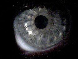 250px-Cornea_transplant